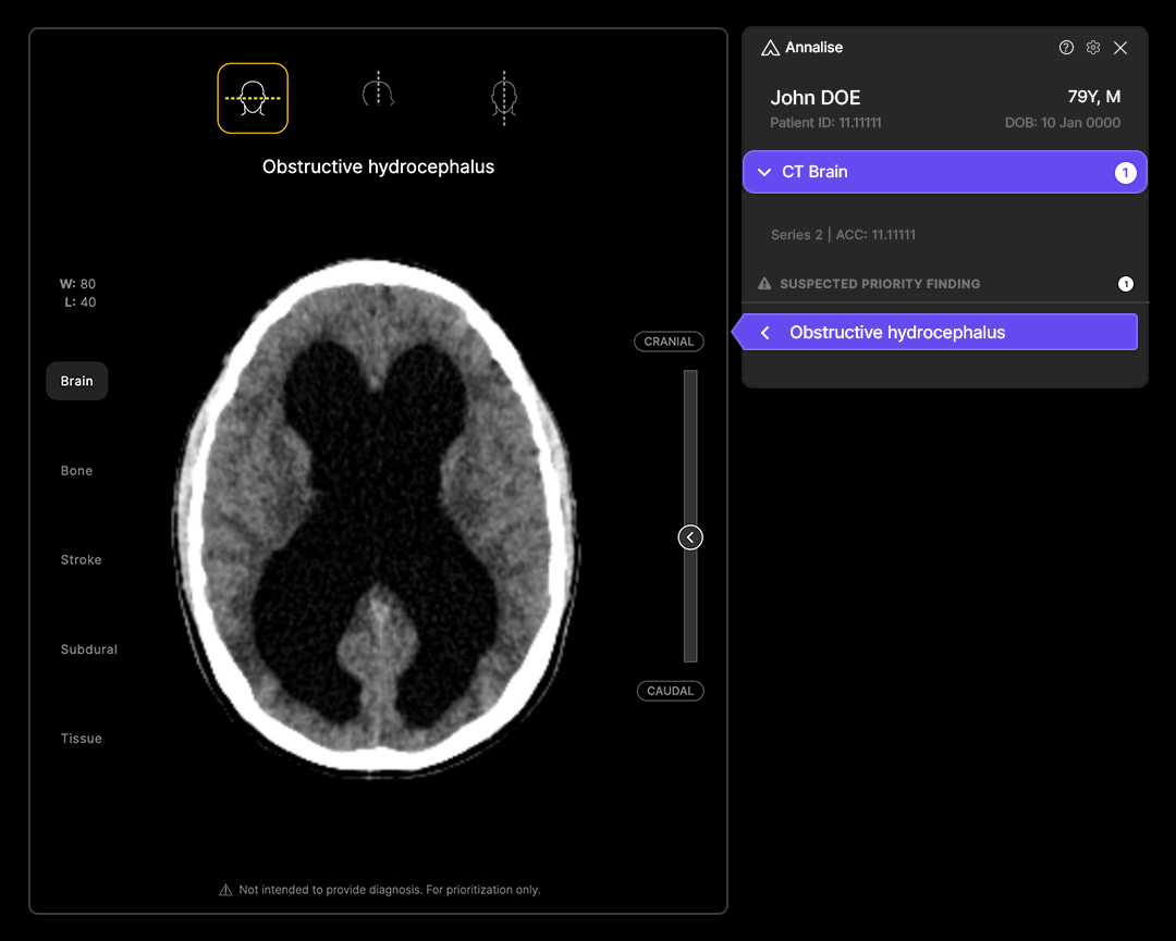 NEW-Clinical-CTB-Triage-US-Obstructive-hydrocephalus