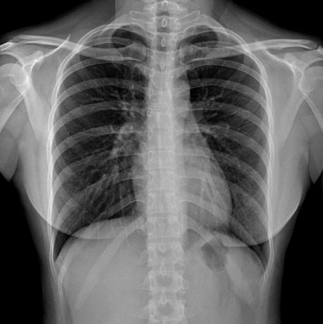 Harrison.ai CXR — AI Chest X-Ray Solution